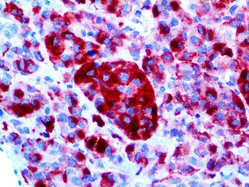 IHC of Melanoma / HMB-45 on an FFPE Malignant Melanoma Tissue
